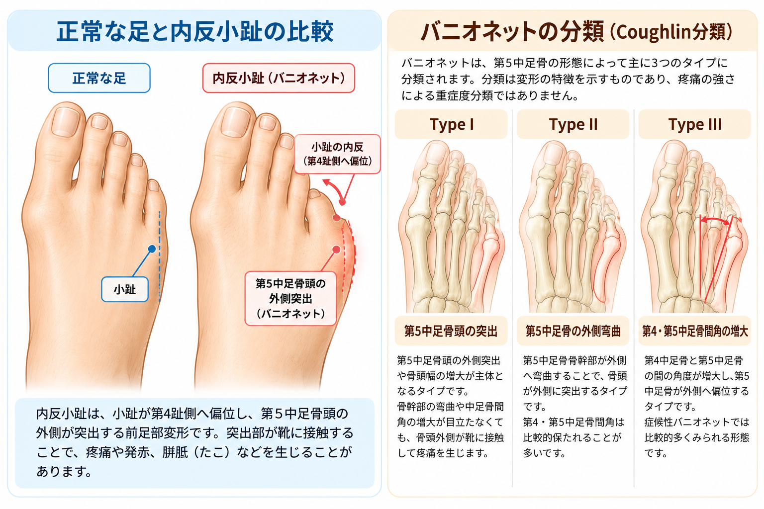 正常な足と内反小趾の比較、およびバニオネットのType I・II・III分類