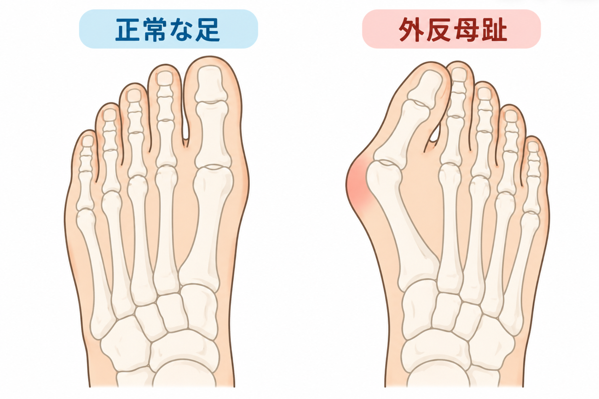 正常な足と外反母趾の比較