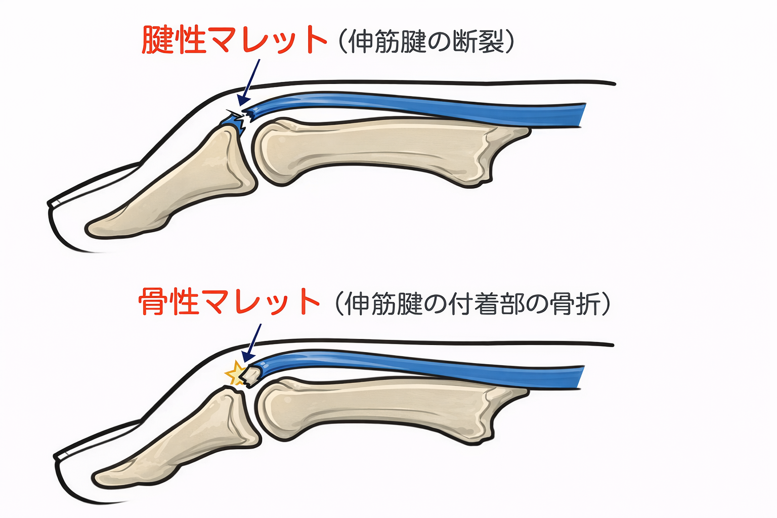 腱性マレットと骨性マレット
