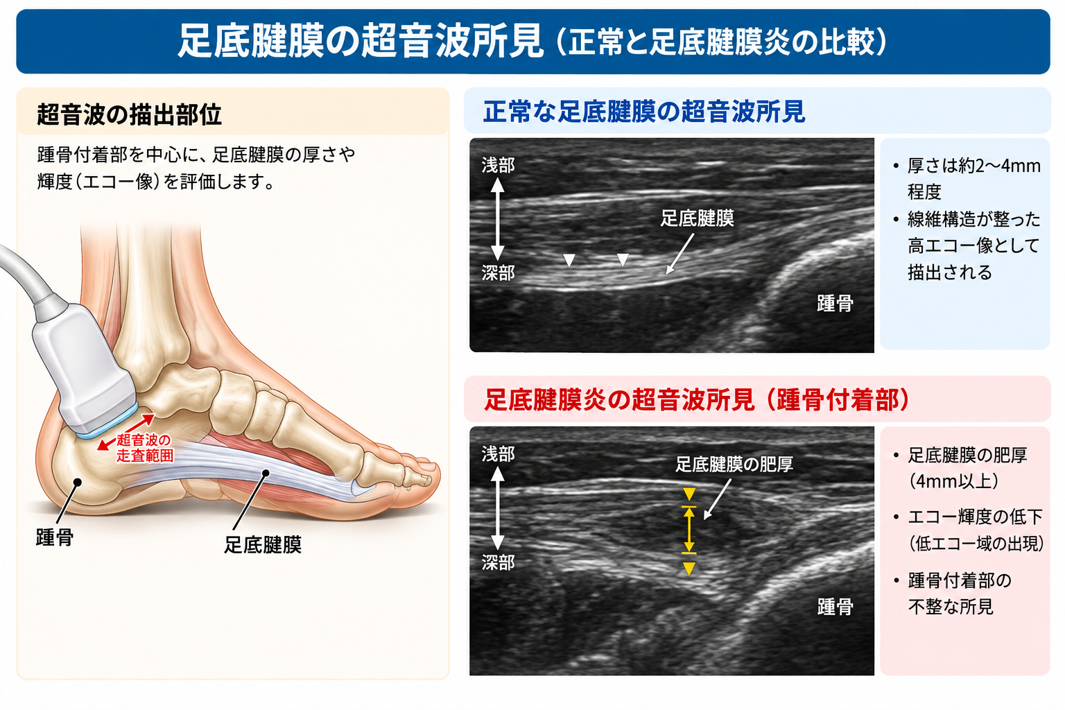 正常な足底腱膜と足底腱膜炎の超音波所見の模式図