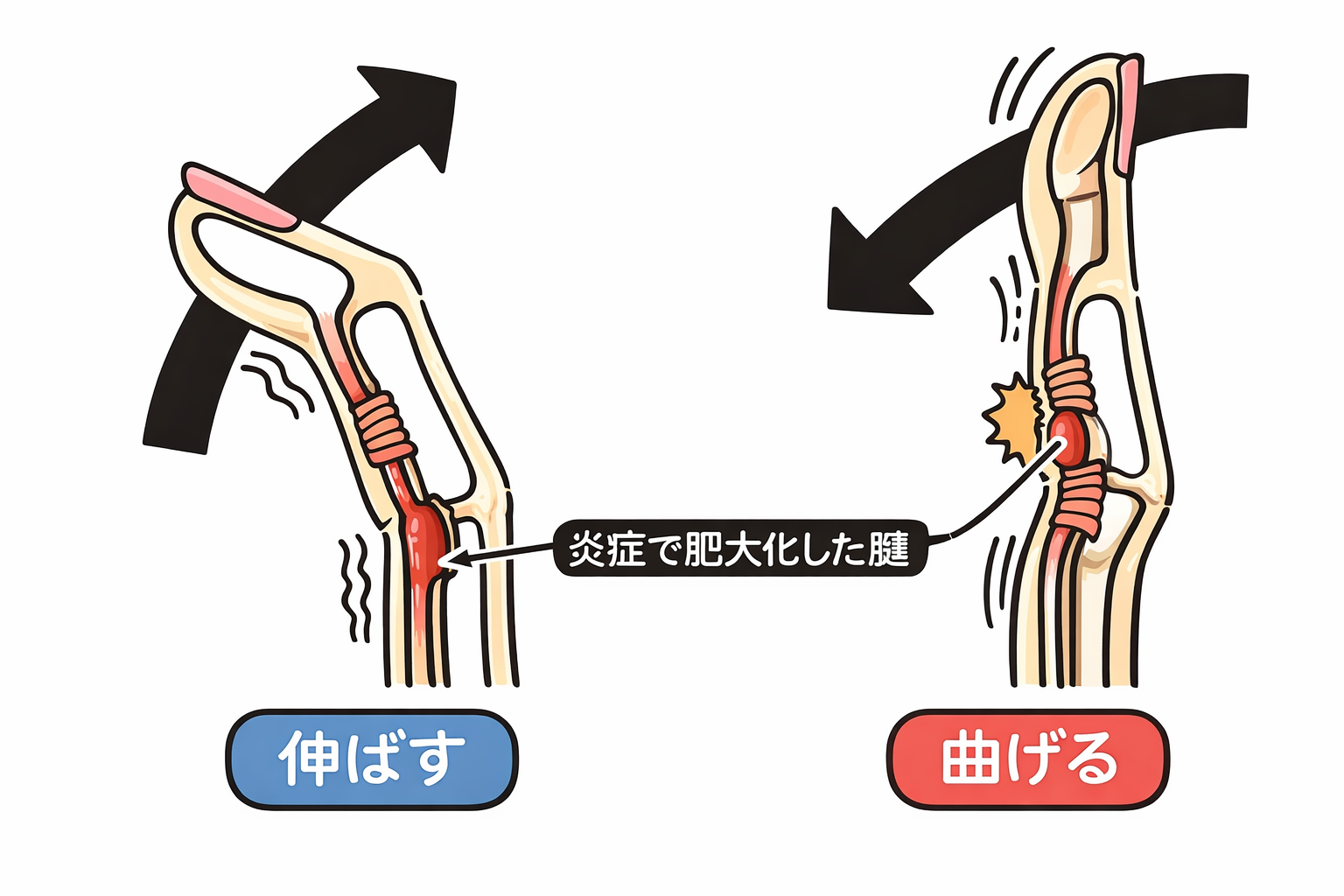 ばね指
